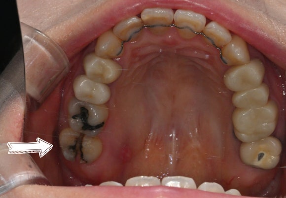 [Implants] Can Teeth Like These Be Saved? (Broken Teeth, Split Teeth) image 8