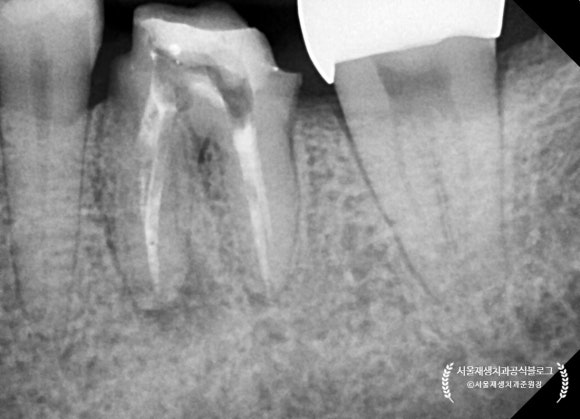[재신경치료] 예전에 신경치료 받은 치아가 갑자기 붓고 아파요! (현미경을 통해 정확하고 섬세하게 재신경치료 하기) 관련 이미지 32