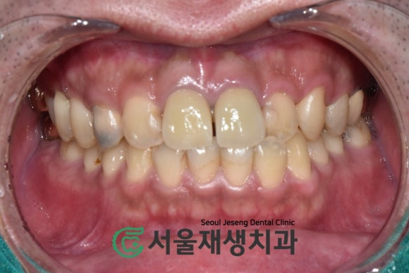 [치아정출술] 충치가 뿌리까지 진행되서 발치해야 한대요...뿌리 깊은 충치도 살려내기 (서울재생치과) 관련 이미지 4