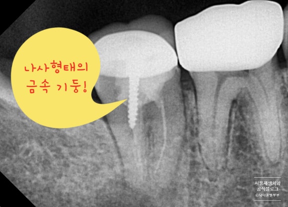 [재신경치료] 치아 뿌리 끝 염증이 너무 심하대요...발치만이 답일까요? 관련 이미지 6