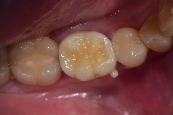 [치아절제술/hemisection] 뿌리가 부러진 소중한 내 어금니..이대로 뽑긴 아까워요. 관련 이미지 6