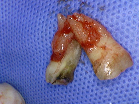 [Implants] Can Teeth Like These Be Saved? (Broken Teeth, Split Teeth) image 9