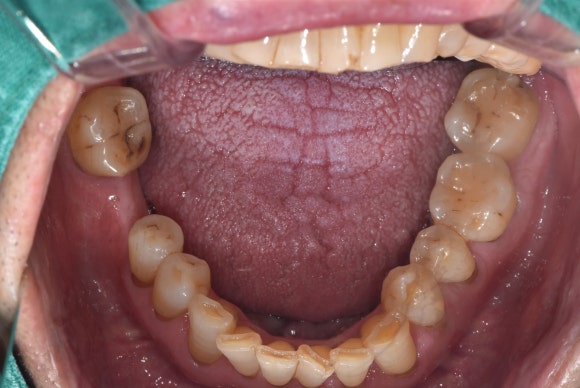 [임플란트] 이가 빠진지 오래되서 옆 치아들이 쓰러졌어요. 임플란트 가능할까요? 네, 가능합니다.1mm의 정교함으로! 관련 이미지 4