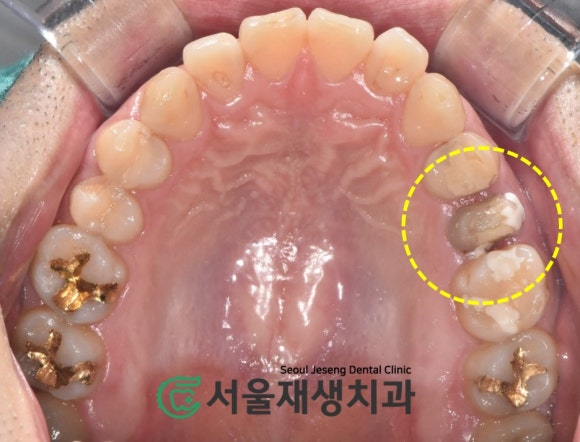 [재신경치료] 다른 치과에서 빼라고 했는데...혹시 살릴 수는 없을까요? (현미경 신경치료, 서울재생치과) 관련 이미지 5