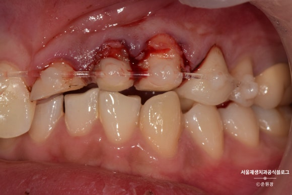 [치아외상] 부러진 앞니, 발치가 답인가요? (사고로 부러진 치아, 외과적정출술로 살리기) 관련 이미지 17