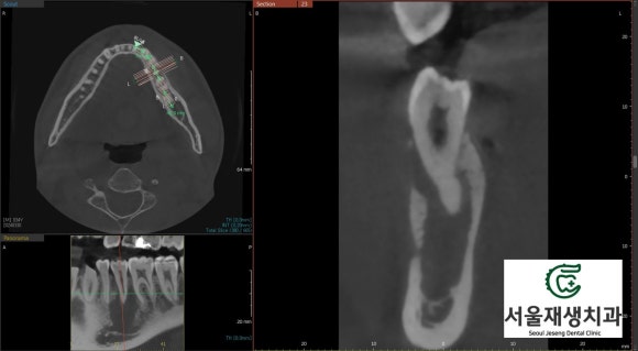 [치외치신경치료] 뿌리 끝 염증이 커서 발치해야된대요! 치아 머리에 볼~록! 알고보면 무서운 작은 혹 (서울재생치과) 관련 이미지 13