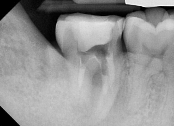 [고난이도 신경치료] 사랑니 때문에 뿌리가 흡수되어 버린 치아...살릴 수 있나요? 관련 이미지 5