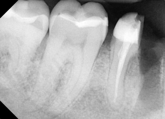 [치아절제술/hemisection] 뿌리가 부러진 소중한 내 어금니..이대로 뽑긴 아까워요. 관련 이미지 4