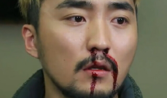 윗 어금니 신경치료 후에 코피가 나요 (신경치료 후 주의사항, 상악동, 신촌 서울재생치과, 신촌 신경치료 맛집, 현미경 신경치료) 관련 이미지 3