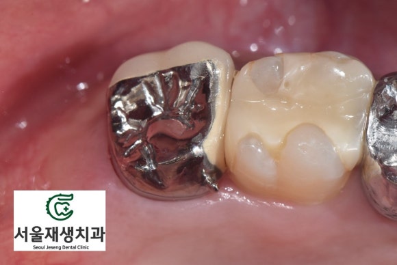 [재신경치료] 예전에 신경치료 한 치아가 갑자기 붓고 아파요! (현미경 신경치료, 서울재생치과) 관련 이미지 13