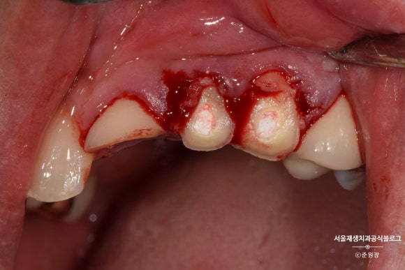 [치아외상] 부러진 앞니, 발치가 답인가요? (사고로 부러진 치아, 외과적정출술로 살리기) 관련 이미지 14