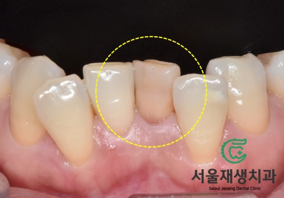 [치아미백] 예전에 부딪힌 앞니가 까맣게 변했어요. 신경이 죽은 치아를 하얗게 돌려놓기! (서울재생치과) 관련 이미지 3