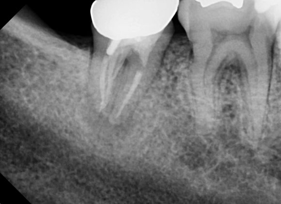 [재신경치료] 잇몸이 부었어요. 다니던 치과에서는 재신경치료 하거나 발치하라고 했어요. 관련 이미지 4