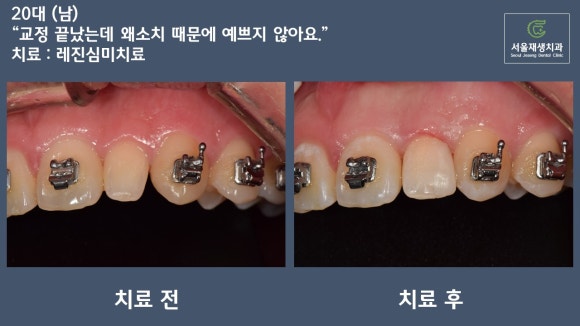 [치료사례] 왜소치/기형치를 크라운 없이 간단하게 치료하는 법 관련 이미지 2
