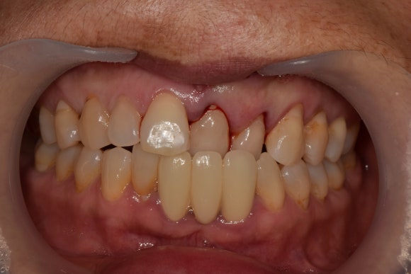 [치아외상] 넘어졌는데 이가 쏘옥 빠졌어요....! (안면부 외상, 치아 탈구, 치아 재식,서울재생치과) 관련 이미지 6