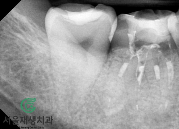 [재신경치료] 3년 전에 신경치료 했던 치아인데 다시 아파요! (미세 현미경 재신경치료, 서울재생치과) 관련 이미지 9