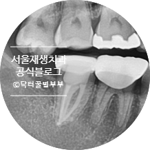 [재신경치료] 치아 뿌리 끝 염증이 너무 심하대요...발치만이 답일까요? 관련 이미지 15