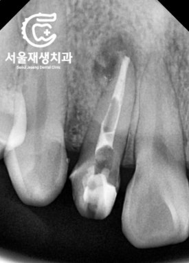 [재신경치료] 소중한 내 앞니...재신경치료로 다시 한 번 살려 쓸 수 있습니다. (서울재생치과, 현미경신경치료) 관련 이미지 9