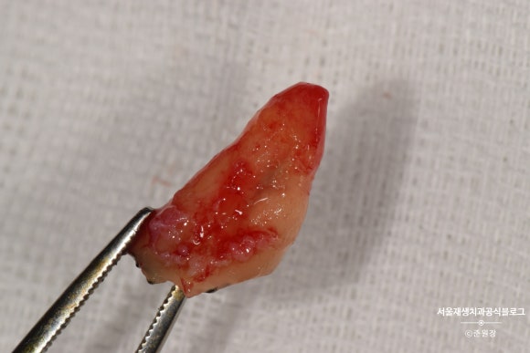 충치나 파절로 짧아진 치아도 다시 보자! (의도적 재식술/치아정출술 후 브릿지치료) 관련 이미지 3