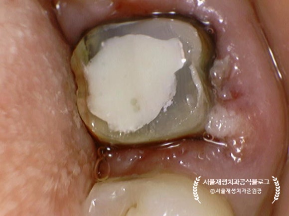 [재신경치료] 예전에 신경치료 받은 치아가 갑자기 붓고 아파요! (현미경을 통해 정확하고 섬세하게 재신경치료 하기) 관련 이미지 33