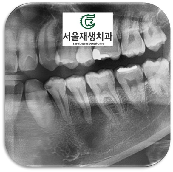 [치외치신경치료] 뿌리 끝 염증이 커서 발치해야된대요! 치아 머리에 볼~록! 알고보면 무서운 작은 혹 (서울재생치과) 관련 이미지 11