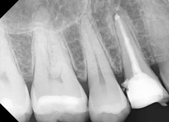 [신경치료] 충치가 커서 뿌리만 남았대요. 비발치 신경치료로 자연치아 살리기! 관련 이미지 8
