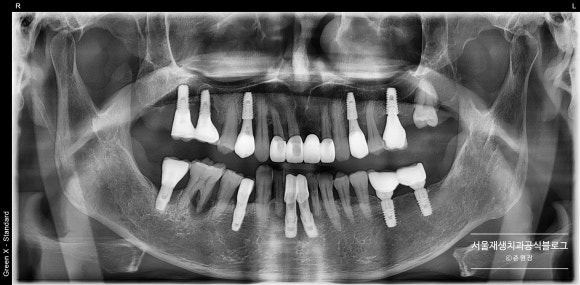임플란트가 아플 때, 임플란트 잇몸이 부었을 때 어떻게 하나요? (임플란트 재수술, 서울재생치과, 신촌치과) 관련 이미지 4