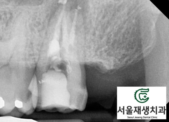 [재신경치료] 40대 남성, 윗 어금니 신경치료 후 상악동까지 염증이 전파된 사례 (서울재생치과 미세현미경치료) 관련 이미지 7