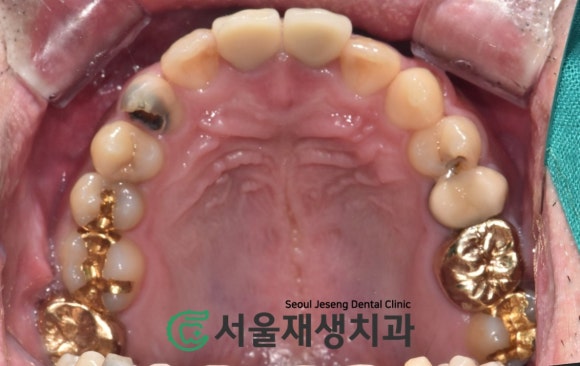 [치아정출술] 충치가 뿌리까지 진행되서 발치해야 한대요...뿌리 깊은 충치도 살려내기 (서울재생치과) 관련 이미지 6