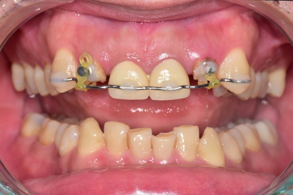 [치아살리기] 크라운 씌운 치아가 부러졌어요. 교정적정출술을 통해 내 치아 끝까지 써보기 관련 이미지 5