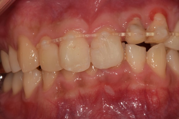 [치아외상] 부러진 앞니, 발치가 답인가요? (사고로 부러진 치아, 외과적정출술로 살리기) 관련 이미지 20
