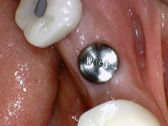 [임플란트] 재신경치료를 시도할 수 없을 때. 뼈이식 없는 임플란트 시술로 간편하게. 관련 이미지 11