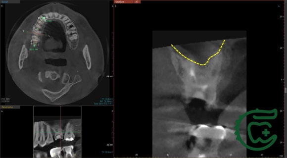 [재신경치료] 다른 치과에서 재신경치료했는데 여전히 불편해요. 40대 남성 환자분의 재재신경치료 이야기. 관련 이미지 6