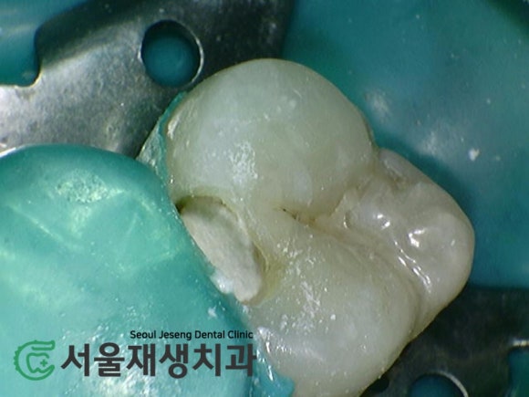[MTA충치치료] 충치가 클 때.. 신경치료 안하고 치료하는 법 (치수복조술, 신촌 서울재생치과) 관련 이미지 11