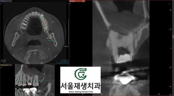 [재신경치료] 재신경치료까지 했는데 계속 아파요..미세 현미경을 이용한 세번째 신경치료! (서울재생치과) 관련 이미지 5