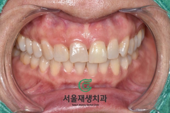 [치아미백] 예전에 다친 치아가 최근에 변색됐어요. 어떻게 해결하나요? (서울재생치과) 관련 이미지 8