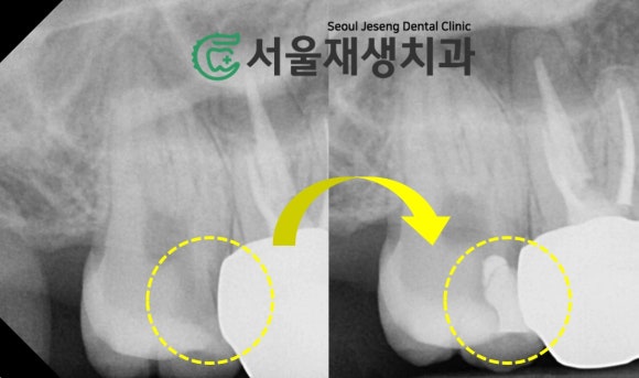 [MTA충치치료] 충치가 클 때.. 신경치료 안하고 치료하는 법 (치수복조술, 신촌 서울재생치과) 관련 이미지 14