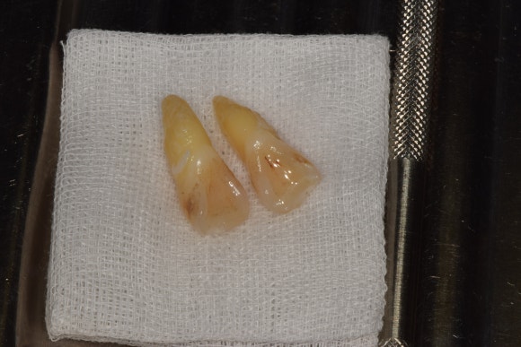 [치아외상] 넘어졌는데 이가 쏘옥 빠졌어요....! (안면부 외상, 치아 탈구, 치아 재식,서울재생치과) 관련 이미지 3