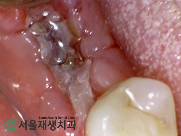 [발치 후 치유과정] 이를 뺀 후 아무는 과정, 단계별 주의사항 (신촌 서울재생치과) 관련 이미지 4