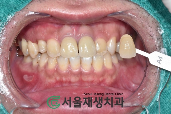 [치아정출술] 충치가 뿌리까지 진행되서 발치해야 한대요...뿌리 깊은 충치도 살려내기 (서울재생치과) 관련 이미지 12