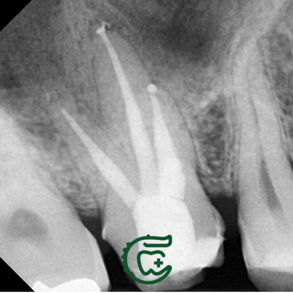 [재신경치료] 다른 치과에서 재신경치료했는데 여전히 불편해요. 40대 남성 환자분의 재재신경치료 이야기. 관련 이미지 7