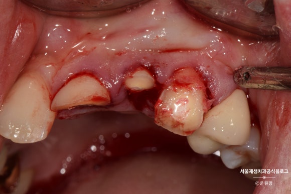 [치아외상] 부러진 앞니, 발치가 답인가요? (사고로 부러진 치아, 외과적정출술로 살리기) 관련 이미지 8