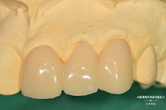 [치아외상] 부러진 앞니, 발치가 답인가요? (사고로 부러진 치아, 외과적정출술로 살리기) 관련 이미지 22