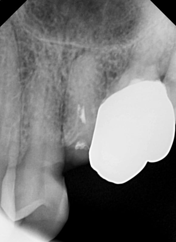 부러진 치아를 살려서 쓰는 법 (잇몸성형과 포스트식립) 관련 이미지 5
