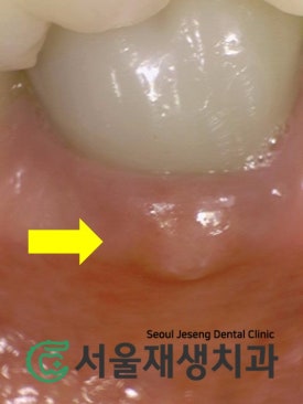 [재신경치료] 신경치료 받은 치아가 붓고 아파요! 현미경과 CT의 도움으로 다시 한 번 꼼꼼하게~ 관련 이미지 8
