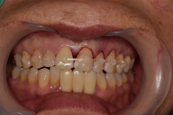 [치아외상] 넘어졌는데 이가 쏘옥 빠졌어요....! (안면부 외상, 치아 탈구, 치아 재식,서울재생치과) 관련 이미지 8