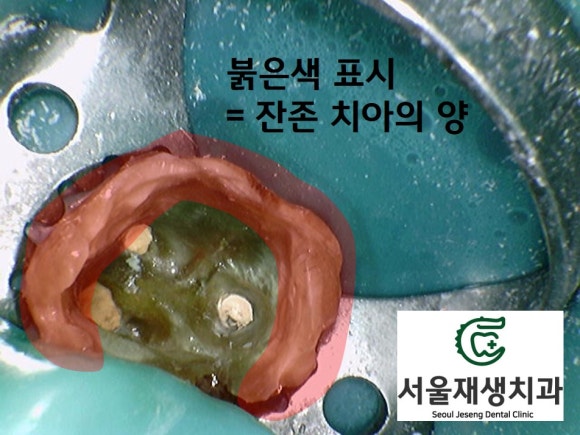 [재신경치료] 타치과에서 재신경치료 하는 중인데 발치를 하자고 했어요... (서울재생치과 현미경 신경치료) 관련 이미지 10