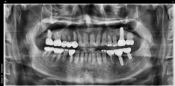 [임플란트] 재신경치료를 시도할 수 없을 때. 뼈이식 없는 임플란트 시술로 간편하게. 관련 이미지 14