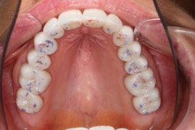 치과에서 치료하는 치아가 아닌 반대편 치아를 갈아내는 이유는? 장기 치료에 반드시 필요한 "정출방지 치아고정"에 대해 알아봅시다. 관련 이미지 6