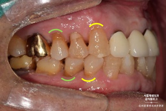 잇몸 패임, 무슨 재료로 때우나요? 레진과 글라스아이오노머(GI)로 치경부마모증 치료하기 (서울재생치과,신촌치과) 관련 이미지 14